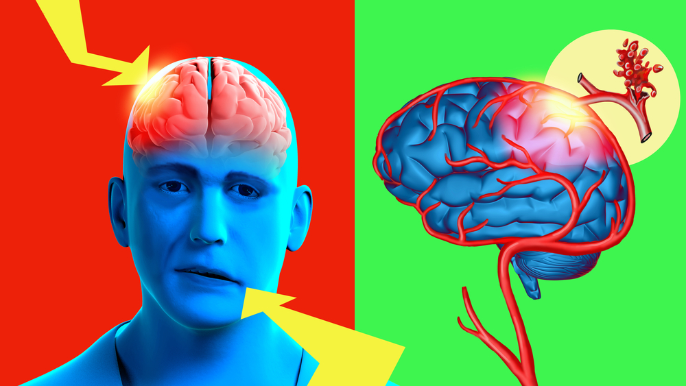 3d,illustration.,facial,asymmetry,is,a,symptom,of,ischemic,stroke.