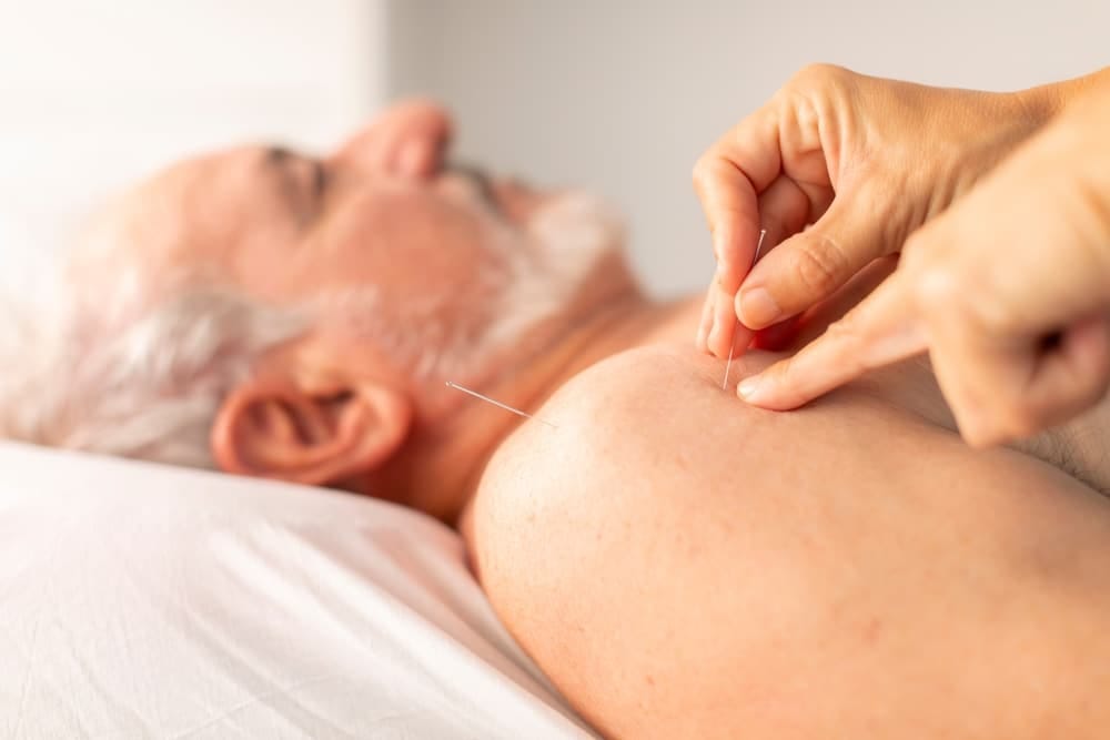 the,hands,of,a,physiotherapist,place,needles,on,the,shoulder